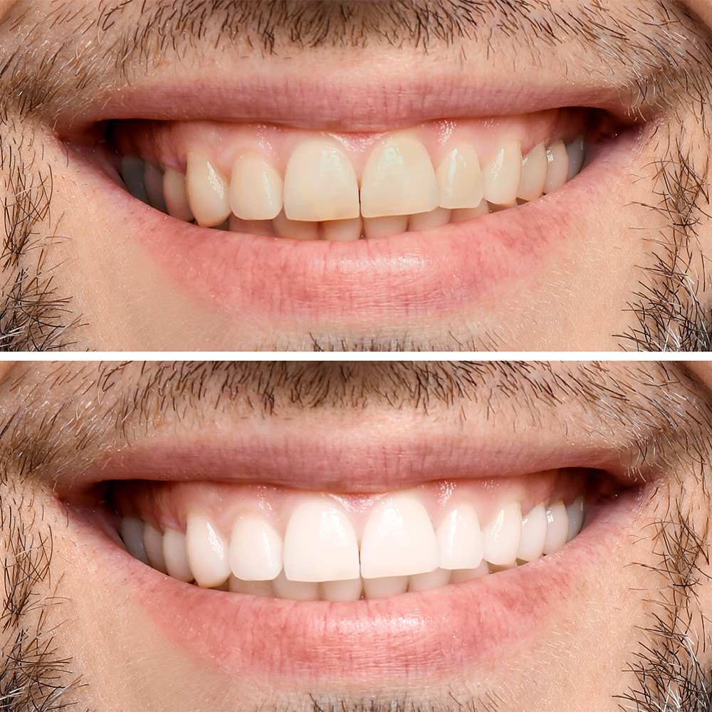 Teeth whitening - Dentist on Bourke